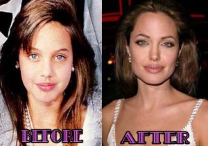 Angelina Jolie Plastic Surgery Before and After Botox Injection Pictures2