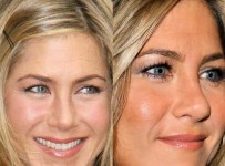 Best Celebrity Nose Jobs Before And After Pictures