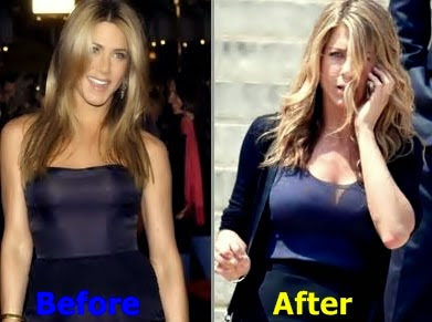 Jennifer Aniston Plastic Surgery Before And After Photos
