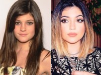 Kylie Jenner Plastic Surgery Before And After