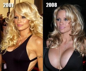 Pamela Anderson Plastic Surgery Before And After photos