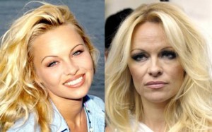 Pamela Anderson Plastic Surgery Before And After photos