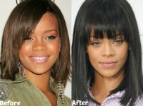 Rihanna Nose Job Plastic Surgery Before And After Pictures 3