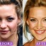 Kate Hudson Nose Job Before and After Photos