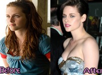 Kristen Stewart Plastic Surgery Before And After Photos