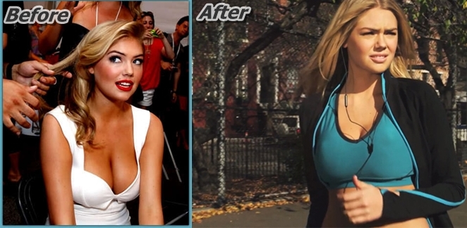 Kate Upton Breast Implants Plastic Surgery Before And After Photos