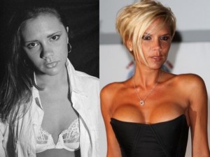 victoria beckham plastic surgery before and after photos
