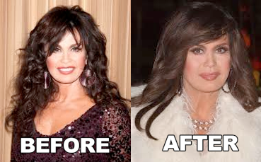 Marie Osmond Botox Plastic Surgery Before and After Face Photos1