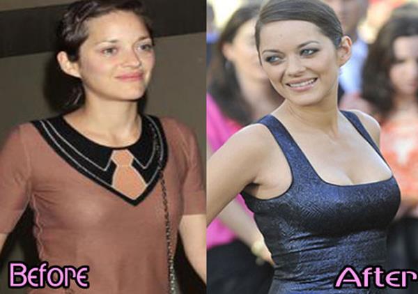 Marion Cotillard Breast Implants Surgery Before and After Photos 2