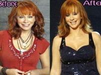 Reba Mcentire plastic surgery before and after photos breast implatns