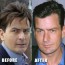 Charlie Sheen Nose Job before after Photos