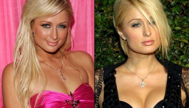 Paris Hilton Breast Implants Plastic Surgery before and after Boobs Job