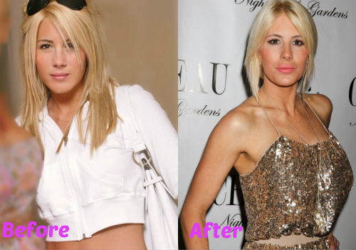 Shayne Lamas breast implants surgery before and after pictures