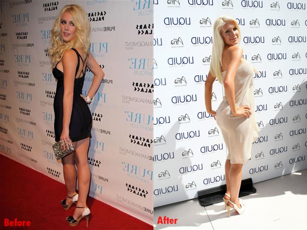Heidi Montag Butt Augmentation Plastic Surgery Before And After Implants Photo