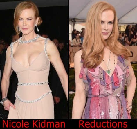 Nicole Kidman Breast Reductions Before And After Boobs Job Plastic Surgery Photos