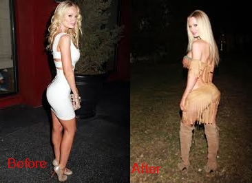 Sophie Turner butt implants before and after plastic surgery pictures