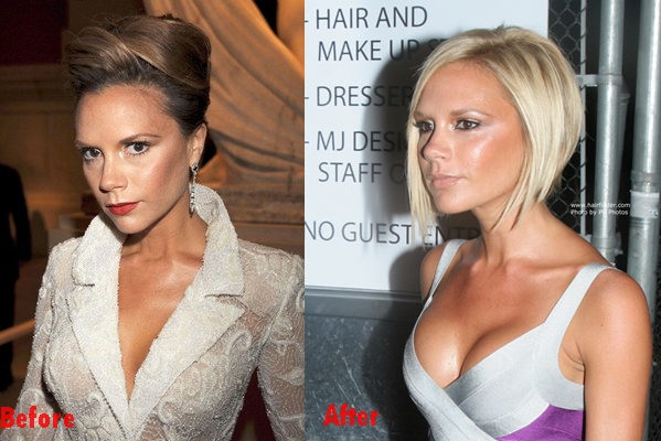 Victoria Beckham Breast Implants Plastic Surgery Before And After Boobs Job