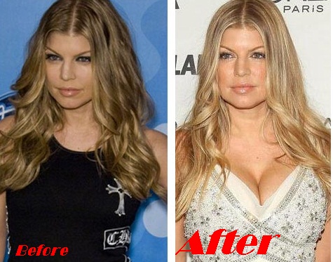 Fergie Breast implants surgery before and after boob job photos 1