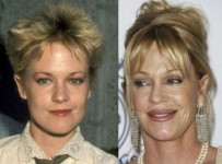 Celebrity plastic surgery gone wrong before and after photos 1