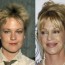 Celebrity plastic surgery gone wrong before and after photos 1