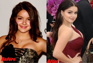 Ariel Winter breast implants before and after pictures