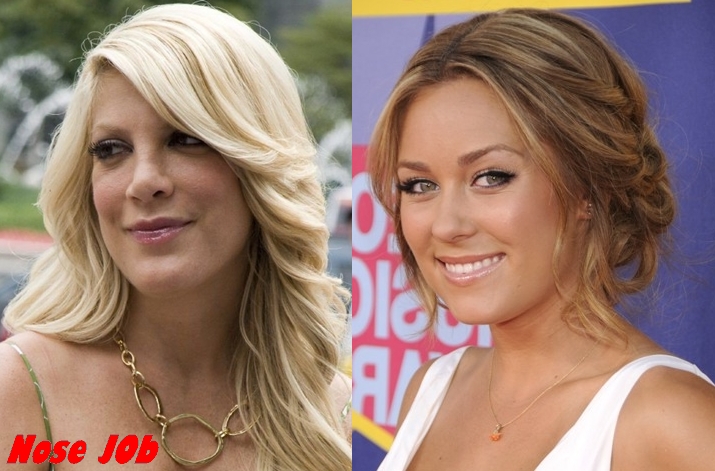 Chanel west coast plastic surgery before and after 2