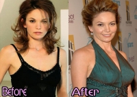 Cheryl Cole Plastic Surgery Breast Implants Before And After Photos Boobs Job 3