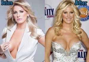 Kim zolciak Breast Implants Surgery Before and After BoobS Job Photos 1