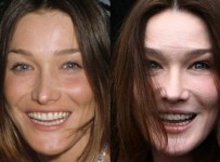Carla Bruni awful plastic surgery before and after photos 2