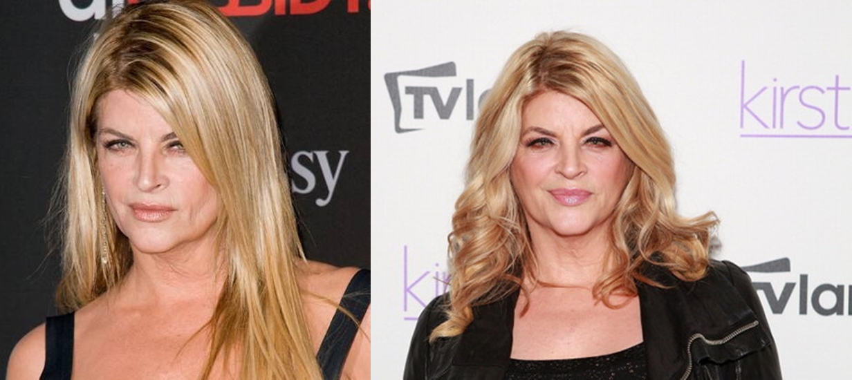 Kirstie Alley plastic surgery before and after photos 1