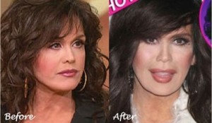 Marie Osmond Plastic Surgery Before And After Photos 3