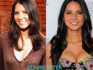Olivia Munn Plastic Surgery Before And After Breast Implants Photos Boob Job 1