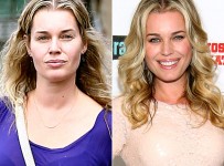 Rebecca Romijn plastic surgery before and after pictures 1