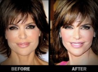 Lisarinna Lips Reduction Plastic Surgery Pictures