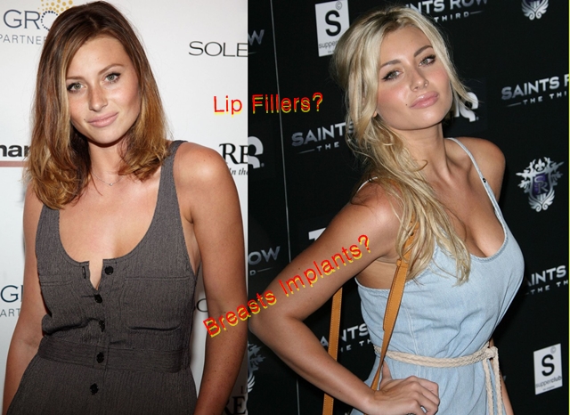 Aly Michalka Breast Implants Before And After Photos