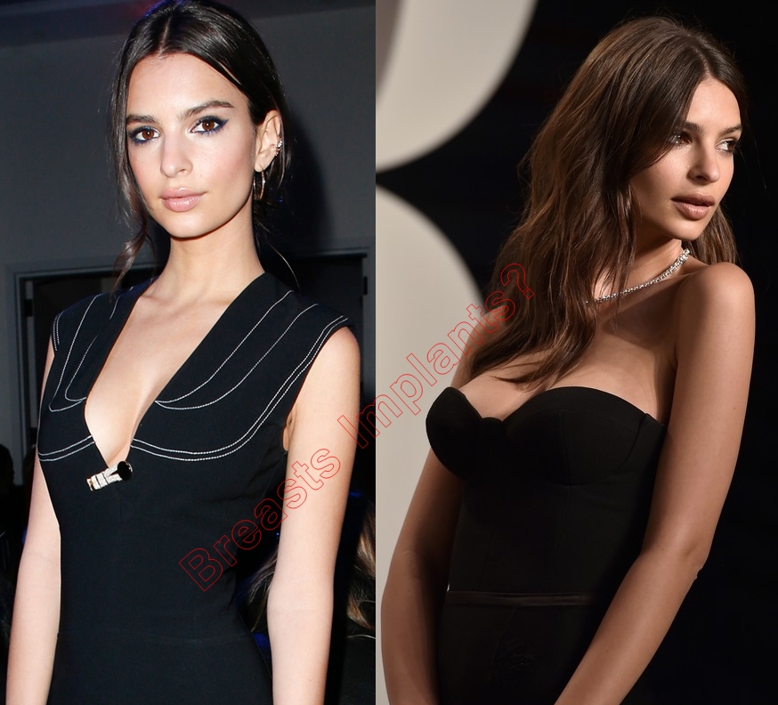 Emily Ratajkowski Breast Implants Plastic Surgery Photos