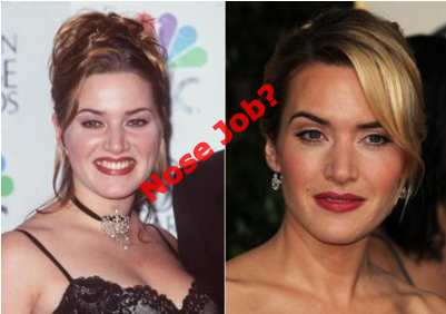 Kate Winslet plastic surgery before and after nose job photos