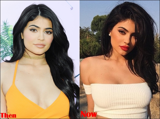 Kylie Jenner Boobs Job Before And After Breasts Implants Photos