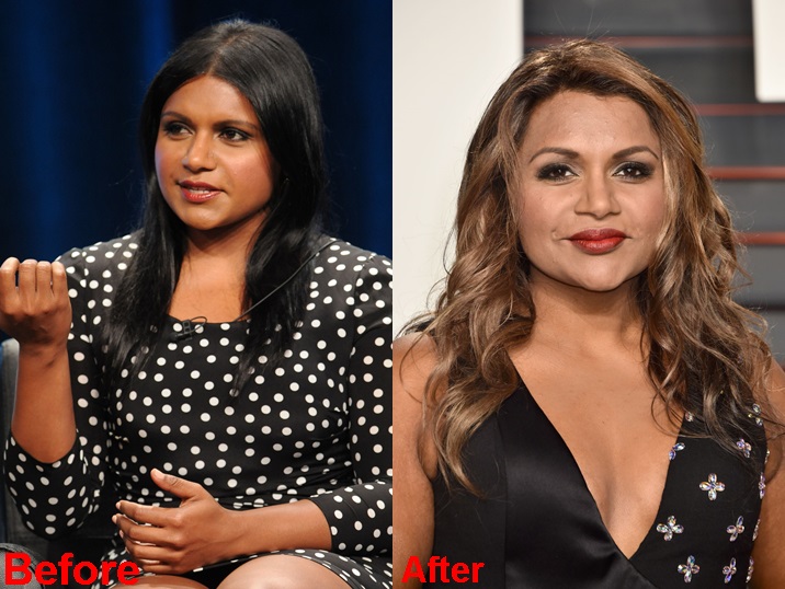 Mindy Kaling plastic surgery before and after photos