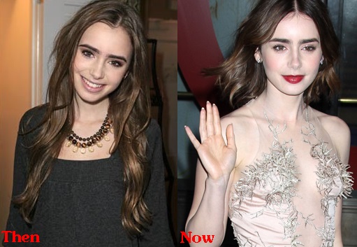 Lily Collins Plastic Surgery Before And After Boobs Job Photos